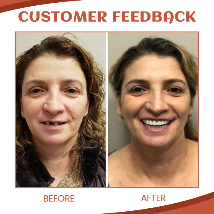 Silicone Denture Set ~ Achieve a natural, confident smile instantly. - Image 6